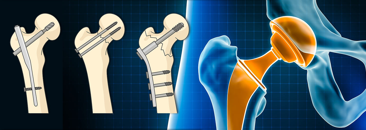 Hip Fracture Banner