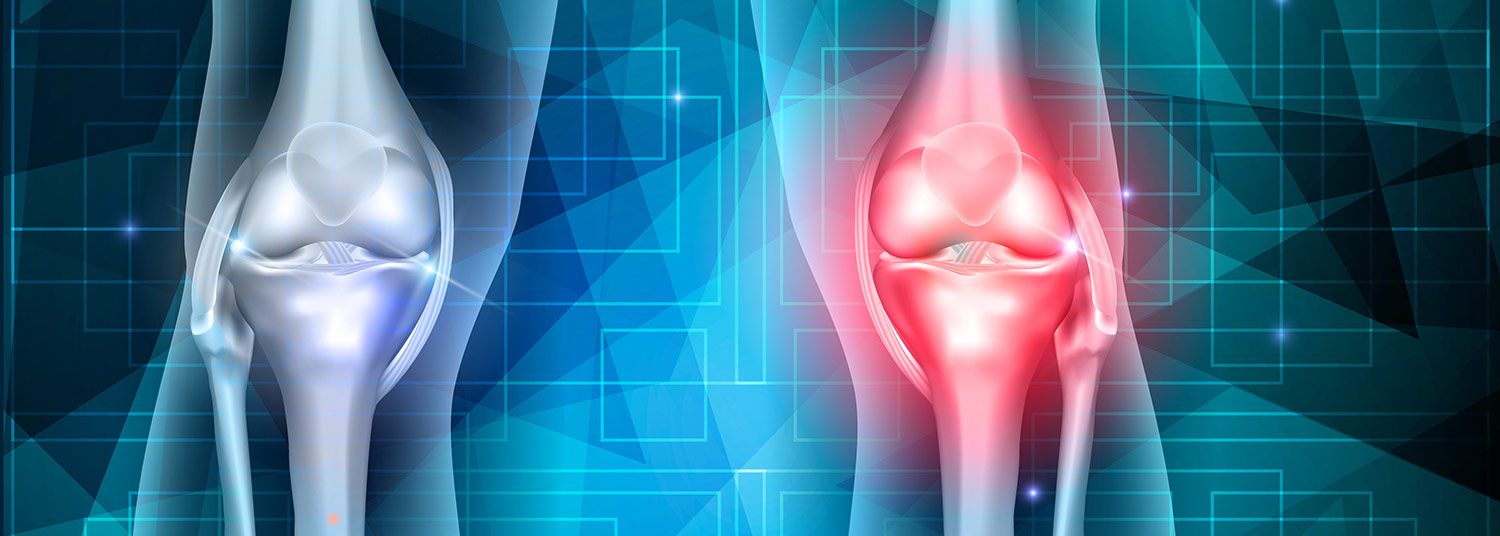 Knee Osteoarthritis Banner