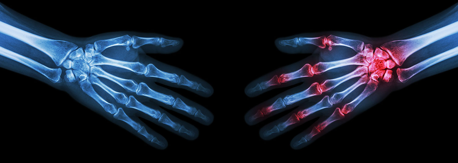 an x-ray depicting two hands reaching for each other. one of the hands has its joints highlighted in red to indicate pain