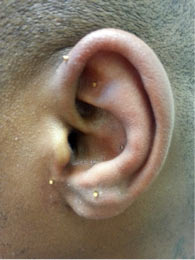 Medical complications of cartilage and ear piercing - ChildrensMD